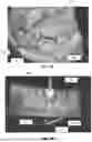 Fig. 05 - INTEGRATED TISSUE MANAGEMENT SOLUTIONS IN ORTHODONTIC ALIGNERS