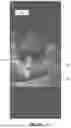 Fig. 06 - INTEGRATED TISSUE MANAGEMENT SOLUTIONS IN ORTHODONTIC ALIGNERS