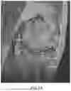 Fig. 09 - SYSTEMS AND METHODS FOR SURGICAL PLANNING OF ARTHROPLASTY PROCEDURES