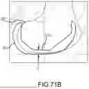 Fig. 197 - SYSTEMS AND METHODS FOR SURGICAL PLANNING OF ARTHROPLASTY PROCEDURES