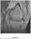 Fig. 22 - SYSTEMS AND METHODS FOR SURGICAL PLANNING OF ARTHROPLASTY PROCEDURES
