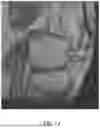 Fig. 28 - SYSTEMS AND METHODS FOR SURGICAL PLANNING OF ARTHROPLASTY PROCEDURES