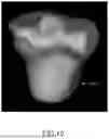 Fig. 32 - SYSTEMS AND METHODS FOR SURGICAL PLANNING OF ARTHROPLASTY PROCEDURES