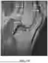 Fig. 35 - SYSTEMS AND METHODS FOR SURGICAL PLANNING OF ARTHROPLASTY PROCEDURES