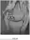 Fig. 52 - SYSTEMS AND METHODS FOR SURGICAL PLANNING OF ARTHROPLASTY PROCEDURES
