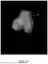 Fig. 53 - SYSTEMS AND METHODS FOR SURGICAL PLANNING OF ARTHROPLASTY PROCEDURES