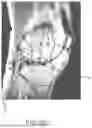 Fig. 63 - SYSTEMS AND METHODS FOR SURGICAL PLANNING OF ARTHROPLASTY PROCEDURES
