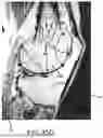 Fig. 64 - SYSTEMS AND METHODS FOR SURGICAL PLANNING OF ARTHROPLASTY PROCEDURES