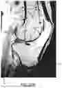 Fig. 65 - SYSTEMS AND METHODS FOR SURGICAL PLANNING OF ARTHROPLASTY PROCEDURES