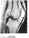 Fig. 67 - SYSTEMS AND METHODS FOR SURGICAL PLANNING OF ARTHROPLASTY PROCEDURES