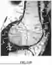 Fig. 72 - SYSTEMS AND METHODS FOR SURGICAL PLANNING OF ARTHROPLASTY PROCEDURES