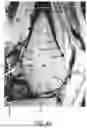 Fig. 76 - SYSTEMS AND METHODS FOR SURGICAL PLANNING OF ARTHROPLASTY PROCEDURES
