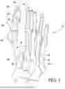 Fig. 02 - Combined Intramedullary - Extramedullary Bone Stabilization and Alignment System
