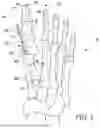 Fig. 04 - Combined Intramedullary - Extramedullary Bone Stabilization and Alignment System
