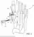 Fig. 06 - Combined Intramedullary - Extramedullary Bone Stabilization and Alignment System