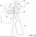 Fig. 22 - Combined Intramedullary - Extramedullary Bone Stabilization and Alignment System