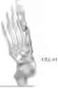 Fig. 58 - Combined Intramedullary - Extramedullary Bone Stabilization and Alignment System