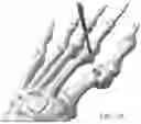 Fig. 75 - Combined Intramedullary - Extramedullary Bone Stabilization and Alignment System