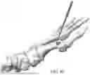Fig. 77 - Combined Intramedullary - Extramedullary Bone Stabilization and Alignment System
