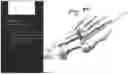 Fig. 83 - Combined Intramedullary - Extramedullary Bone Stabilization and Alignment System