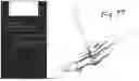 Fig. 85 - Combined Intramedullary - Extramedullary Bone Stabilization and Alignment System