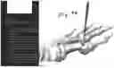 Fig. 89 - Combined Intramedullary - Extramedullary Bone Stabilization and Alignment System