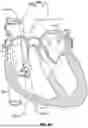 Fig. 44 - MULTI-MODALITY ABLATION CATHETER HAVING A SHAPE MEMORY STYLET
