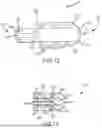 Fig. 08 - ABLATION CATHETER DESIGNS AND METHODS WITH ENHANCED DIAGNOSTIC CAPABILITIES