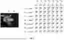 Fig. 06 - PREOPERATIVE SURGICAL PLANNING SYSTEMS AND METHODS FOR PERFORMING RANGE OF MOTION ANALYSIS