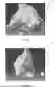 Fig. 06 - LEFT ATRIAL APPENDAGE CLOSURE PRE-PROCEDURE SYSTEM AND METHODS