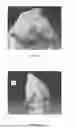 Fig. 07 - LEFT ATRIAL APPENDAGE CLOSURE PRE-PROCEDURE SYSTEM AND METHODS