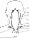 Fig. 03 - SYSTEMS AND METHODS OF REMOVING CHALLENGING CLOTS AND RESTORING PERFUSION TO A VESSEL