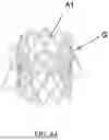 Fig. 09 - ARTIFICIAL HEART VALVE PROSTHESIS ANCHORING DEVICE AND KIT AND USING METHOD