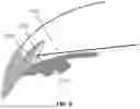 Fig. 08 - Systems and methods for treating patients with closed-angle or narrow-angle glaucoma using an excimer laser unit