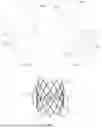 Fig. 02 - Prosthetic heart valve device, delivery system, interventional system and related method