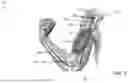 Fig. 02 - BICEP TENODESIS ATHROSCOPIC STAPLE