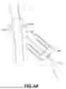 Fig. 09 - BICEP TENODESIS ATHROSCOPIC STAPLE