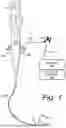 Fig. 02 - SUCTION CANNULA FOR REMOVAL OF DUCT BLOCKAGE