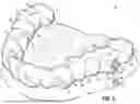 Fig. 04 - ORTHODONTIC APPLIANCES, ATTACHMENTS, SYSTEMS INCLUDING APPLIANCES AND ATTACHMENTS, AND METHODS FOR ORTHODONTIC APPLIANCE AND ATTACHMENT FABRICATION