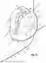 Fig. 15 - ORTHODONTIC APPLIANCES, ATTACHMENTS, SYSTEMS INCLUDING APPLIANCES AND ATTACHMENTS, AND METHODS FOR ORTHODONTIC APPLIANCE AND ATTACHMENT FABRICATION