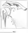 Fig. 02 - GLENOID REPLACEMENT SYSTEM AND METHODS OF IMPLANTING SAID GLENOID REPLACEMENT