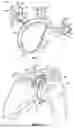 Fig. 07 - GLENOID REPLACEMENT SYSTEM AND METHODS OF IMPLANTING SAID GLENOID REPLACEMENT