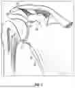 Fig. 02 - GLENOID REPLACEMENT SYSTEM AND METHODS OF IMPLANTING SAID GLENOID REPLACEMENT