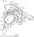 Fig. 05 - GLENOID REPLACEMENT SYSTEM AND METHODS OF IMPLANTING SAID GLENOID REPLACEMENT