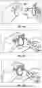 Fig. 10 - GLENOID REPLACEMENT SYSTEM AND METHODS OF IMPLANTING SAID GLENOID REPLACEMENT