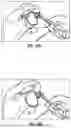 Fig. 11 - GLENOID REPLACEMENT SYSTEM AND METHODS OF IMPLANTING SAID GLENOID REPLACEMENT