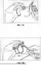 Fig. 13 - GLENOID REPLACEMENT SYSTEM AND METHODS OF IMPLANTING SAID GLENOID REPLACEMENT