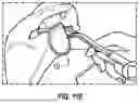 Fig. 15 - GLENOID REPLACEMENT SYSTEM AND METHODS OF IMPLANTING SAID GLENOID REPLACEMENT