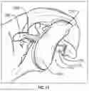Fig. 17 - GLENOID REPLACEMENT SYSTEM AND METHODS OF IMPLANTING SAID GLENOID REPLACEMENT