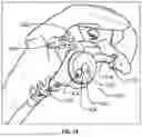 Fig. 18 - GLENOID REPLACEMENT SYSTEM AND METHODS OF IMPLANTING SAID GLENOID REPLACEMENT